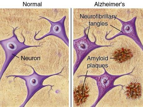 Il deficit di zolfo, il morbo di Alzheimer ed il morbo di Parkinson