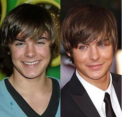 Le star prima e dopo il chirurgo: Zac Efron