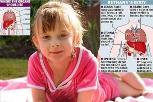 Bethany la piccola di 6 anni con gli organi al contrario