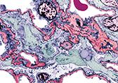 Sclerosi Multipla: il ruolo delle nanotecnologie e della CCSVI