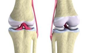 artrosi cartilagine