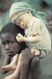 albinism africa