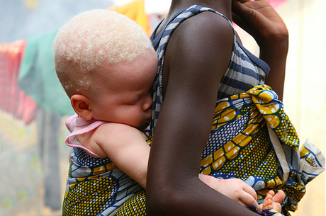 africa albino