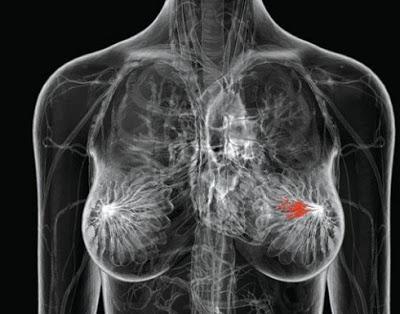 Cancro al seno prevenire con una pillola? Forse si puo' ecco come.