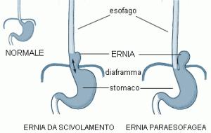 Ernia iatale, dieta e consigli