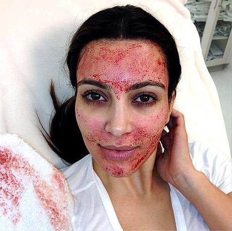 Kim Kardashian mostra le immagini shock del suo ultimo trattamento estetico