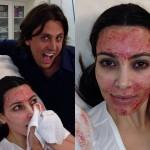 Kim Kardashian, viso coperto di sangue: è il nuovo trattamento per la pelle