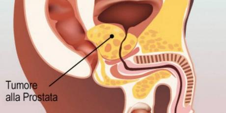 oncologia-tumore-prostata-ranghos