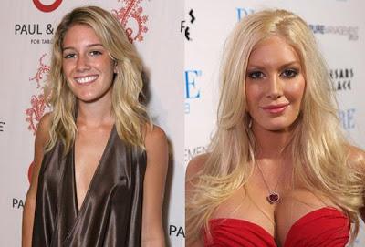 Le star prima e dopo il chirurgo: Heidi Montag