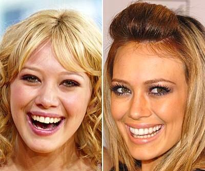 Le star prima e dopo il chirurgo: Hillary Duff