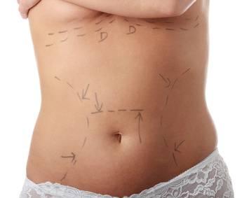 Liposuzione addominale