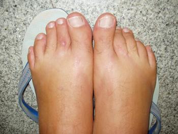 Piedi gonfi: quando i piedi diventano gommoni