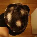 Alopecia androgenetica