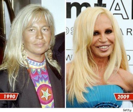 Le star prima e dopo il chirurgo: Donatella Versace