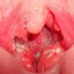 La tonsillite, come affrontarla