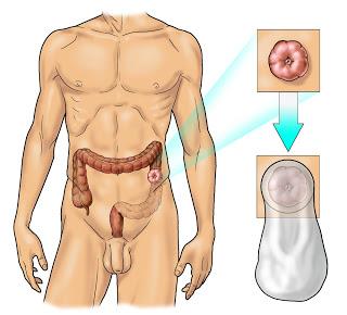 LE GESTIONE DELLE STOMIE INTESTINALI