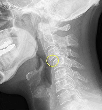 Esercizi per la cervicale, preziosi alleati per prevenire il dolore al collo