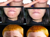 Apple gone Free: Brufoli imperfezioni della pelle, l’app Pimple Remover