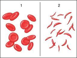 Anemia falciforme