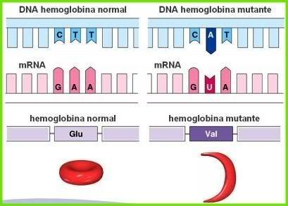 Anemia falciforme