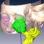 Viso ricostruito grazie a scanner 3d: tumore se lo stava mangiando