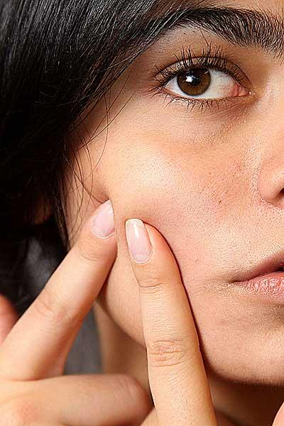 Cicatrici acne, curarle è possibile