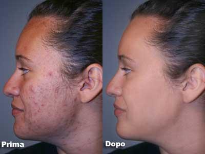 Cicatrici acne, curarle è possibile