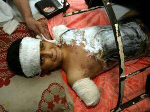 IRAQI BOY WOUNDED IN AIRSTRIKE LIES IN A HOSPITAL IN BAGHDAD