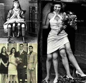 Josephine Myrtle Corbin: la donna nata con quattro gambe