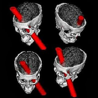 PHINEAS GAGE E L'ERRORE DI CARTESIO