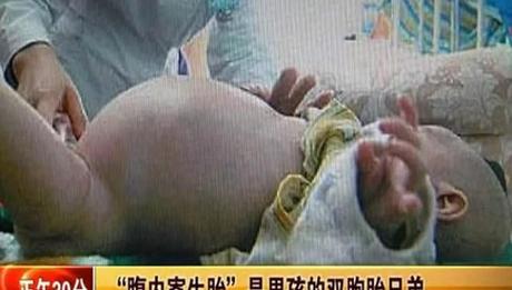 Cina, un bambino di due anni ha il fratello nella pancia