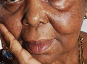 Cesaria evora operata d'urgenza