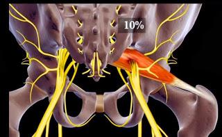 Immagini relative al rapporto anatomico tra nervo sciatico e muscolo piriforme