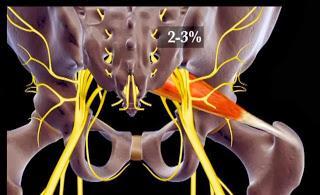 Immagini relative al rapporto anatomico tra nervo sciatico e muscolo piriforme