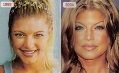 Le star prima e dopo il chirurgo: Fergie