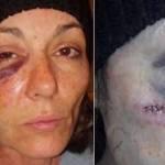 Usa, poliziotto pesta a sangue donna: volto sfigurato (Video)