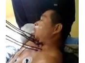 Cina, imprenditore trafitto sette sbarre metallo sopravvive (Foto)