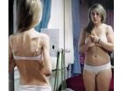 Anoressia anni: “Insalata sotto cuscino mangiare”