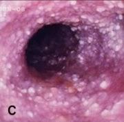 TUMORE INTESTINALE E INTOLLERANZA AL GLUTINE NEL CANE E NEL GATTO