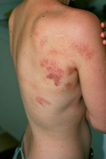 Orticaria da freddo, come lenire il prurito