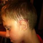 Alfie Hazell, 10 anni, ha orecchio sinistro ricostruito dalle costole (Foto)