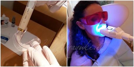 NatSmile: lo Sbiancamento Dentale Cosmetico Naturale