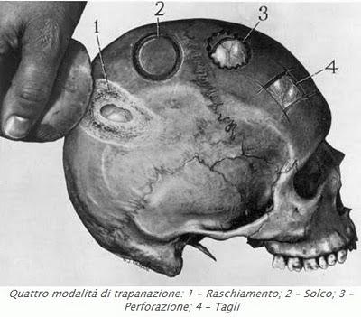 La trapanazione del cranio nel Neolitico