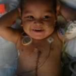 Adonis Ortiz, 3 anni, sopravvive a trapianto di 5 organi (Video)