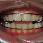 Malposizione del primo dente definitivo: la risposta del Dentista