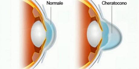 Cheratocono