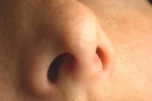Poliposi nasale