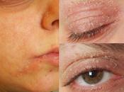 Skinacne