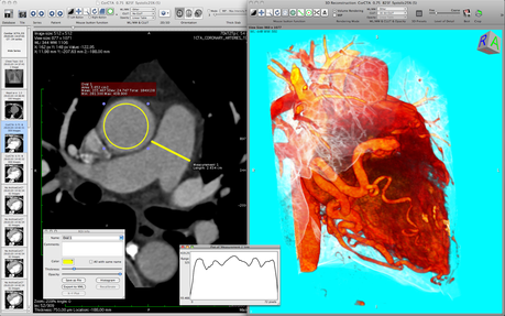 Osirix troppo professionale per essere Open Source