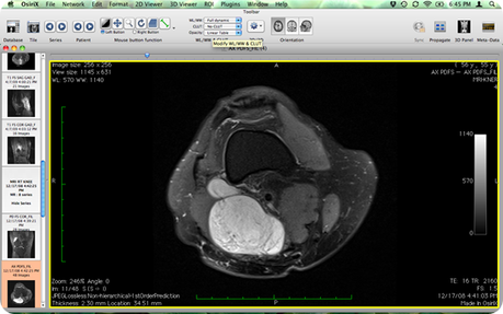 osirix-MRI1